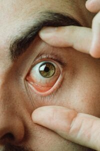 Person versucht vorsichtig, eine weiche Kontaktlinse aus dem Auge zu entfernen. Tipps und Hilfe bei festsitzenden Kontaktlinsen von Hören & Sehen Radulea in Mannheim.