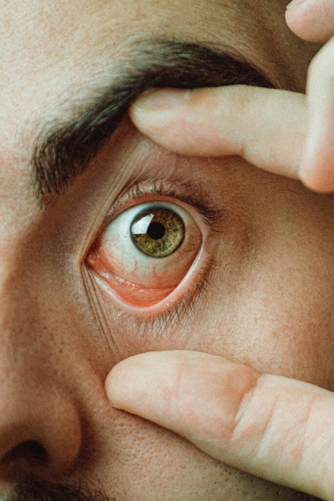 Person versucht vorsichtig, eine weiche Kontaktlinse aus dem Auge zu entfernen. Tipps und Hilfe bei festsitzenden Kontaktlinsen von Hören & Sehen Radulea in Mannheim.